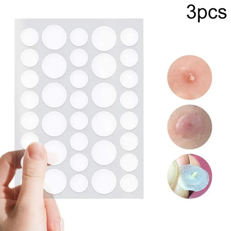 Bộ 3 dụng cụ trị mụn, điều trị sẹo mụn, miếng dán mụn