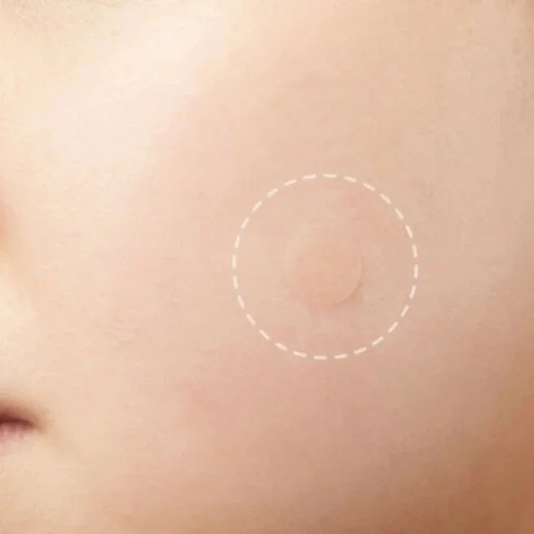 Bộ 3 dụng cụ trị mụn, điều trị sẹo mụn, miếng dán mụn