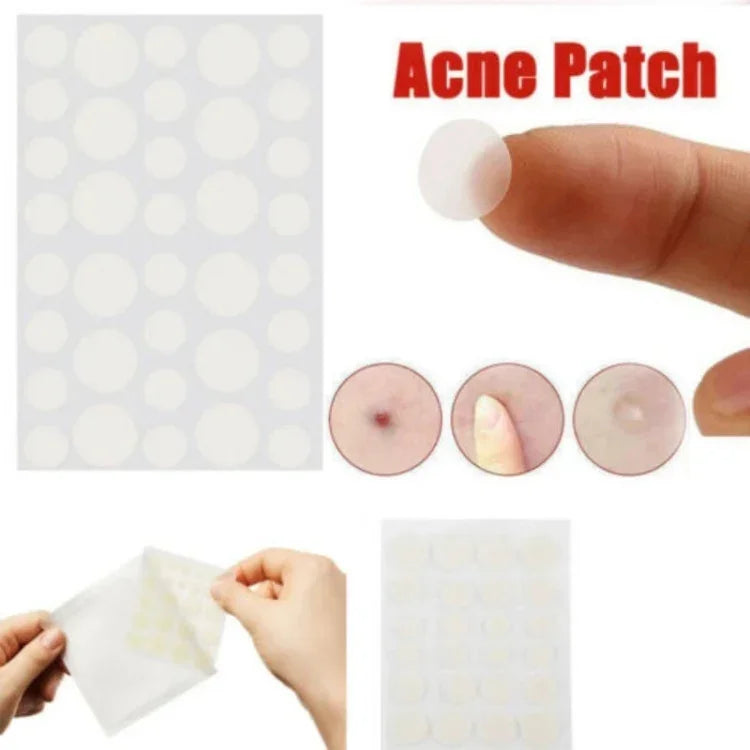 Bộ 3 dụng cụ trị mụn, điều trị sẹo mụn, miếng dán mụn
