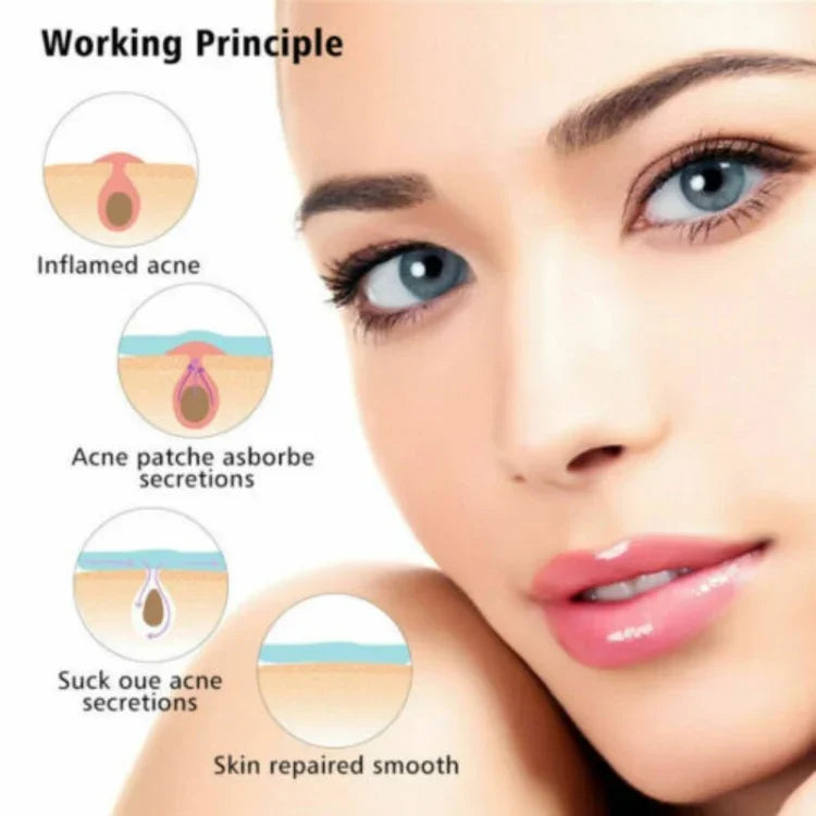 Bộ 3 dụng cụ trị mụn, điều trị sẹo mụn, miếng dán mụn
