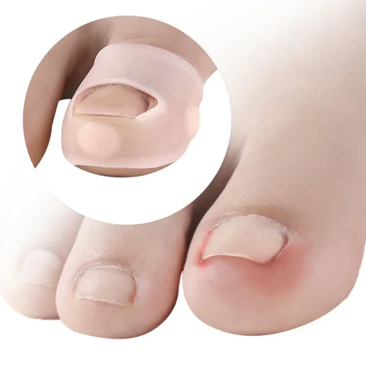 Dụng cụ ngăn ngừa móng mọc vào thịt, chỉnh móng, cỡ tự do