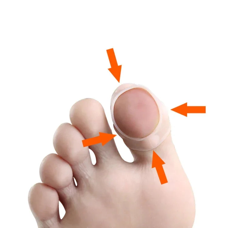 Dụng cụ ngăn ngừa móng mọc vào thịt, chỉnh móng, cỡ tự do