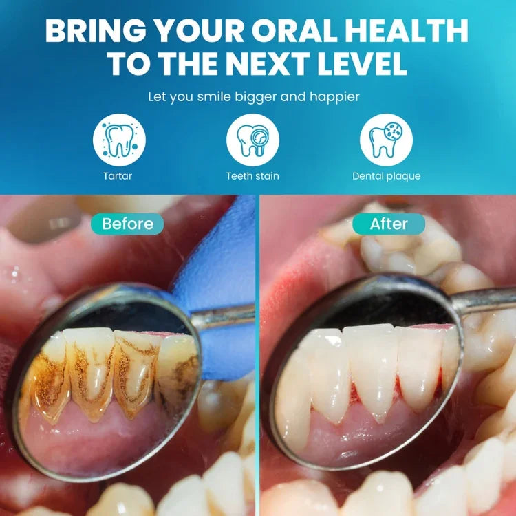 Máy cạo vôi răng siêu âm, thiết bị làm sạch răng tại nhà