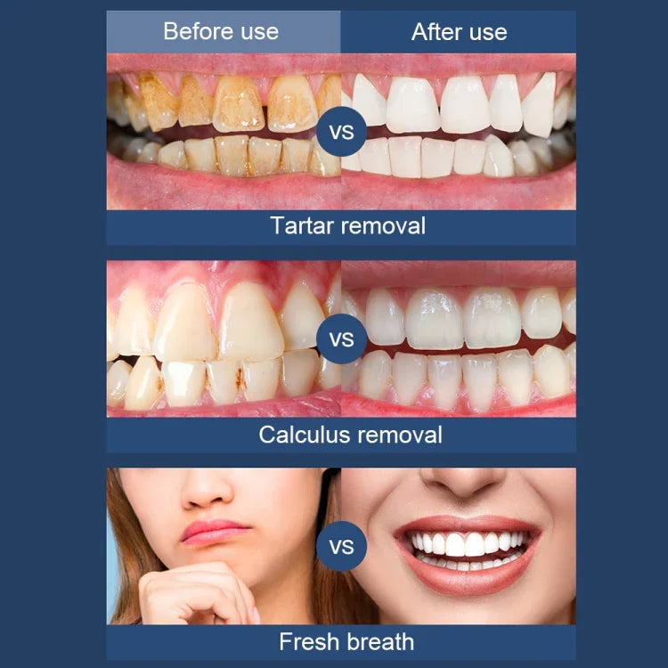 Máy cạo siêu âm điện cầm tay làm sạch răng tại nhà, thiết bị cạo vôi răng di động