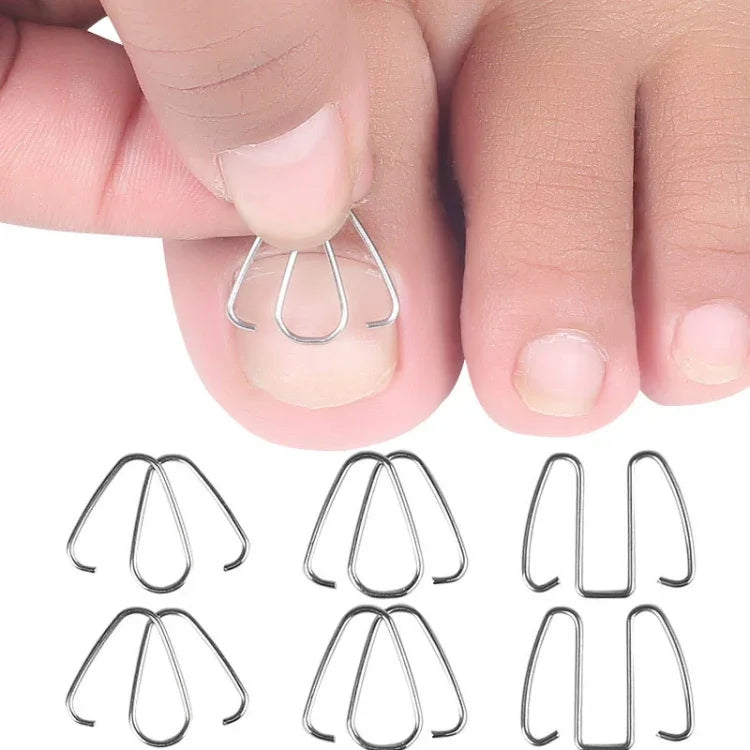6 chiếc / hộp móng chỉnh hình dây kim loại cắm móng chân chỉnh hình móng