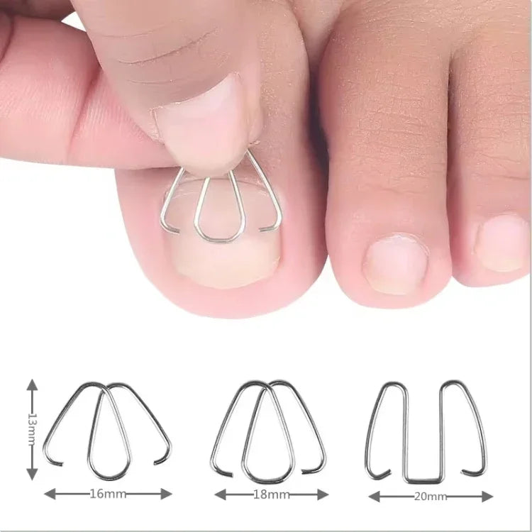 6 chiếc / hộp móng chỉnh hình dây kim loại cắm móng chân chỉnh hình móng