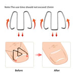 6 chiếc / hộp móng chỉnh hình dây kim loại cắm móng chân chỉnh hình móng