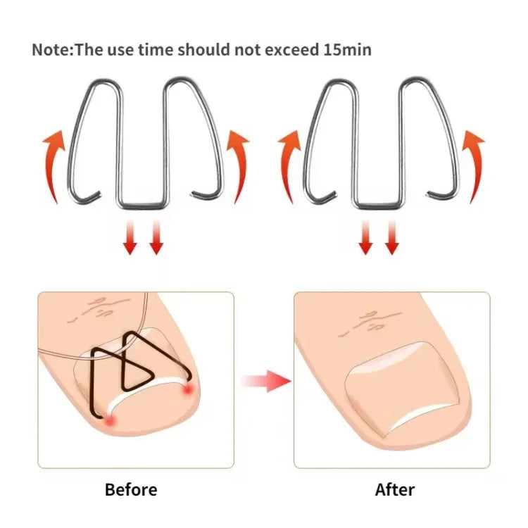 6 chiếc / hộp móng chỉnh hình dây kim loại cắm móng chân chỉnh hình móng