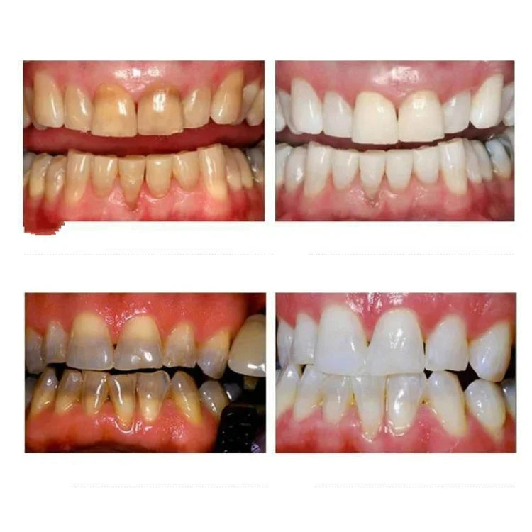 Bộ làm trắng răng nano chuyên nghiệp và làm sạch miệng